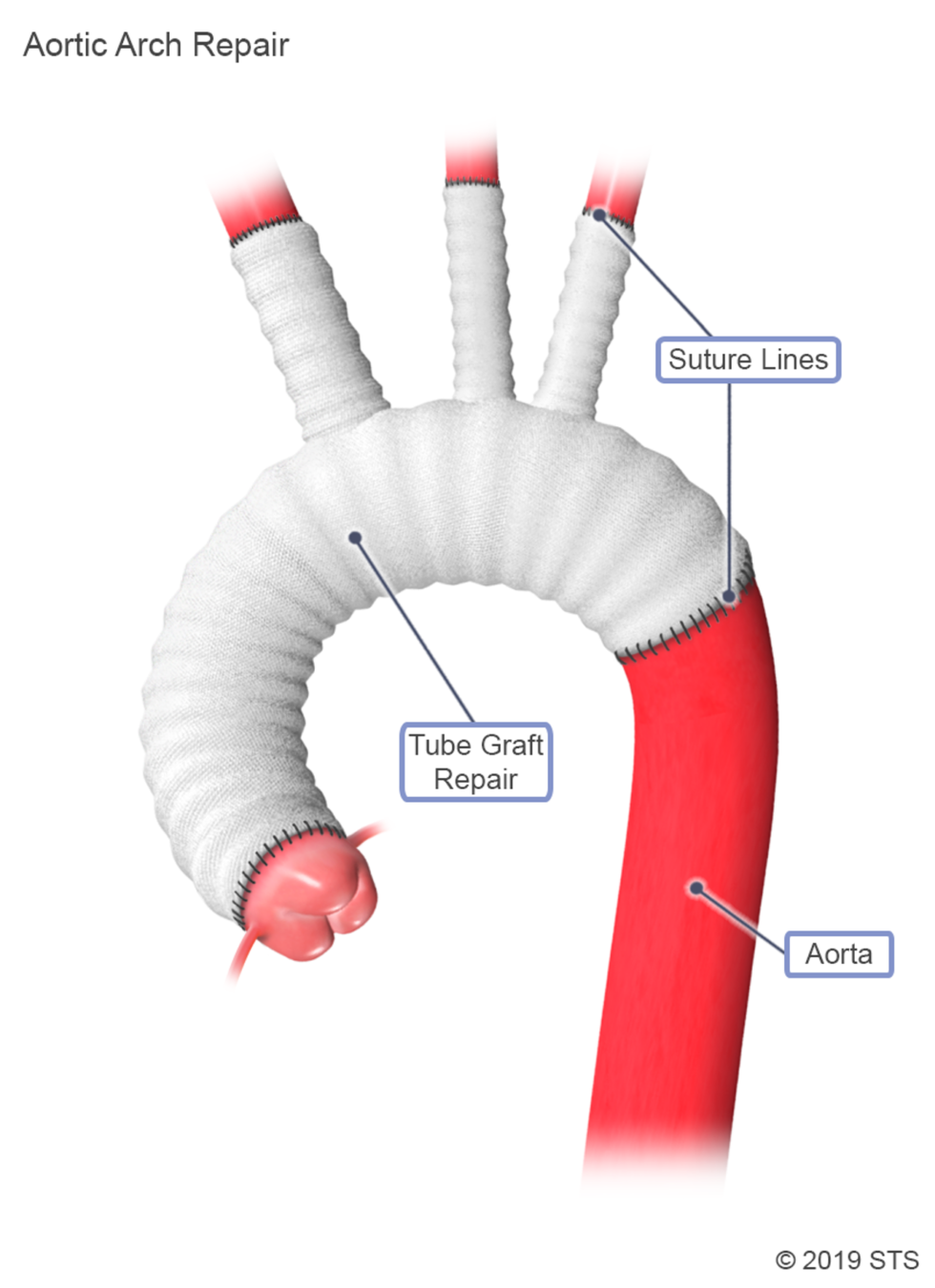 Thoracic Aortic Aneurysm Newport Cardiac Thoracic Surgery