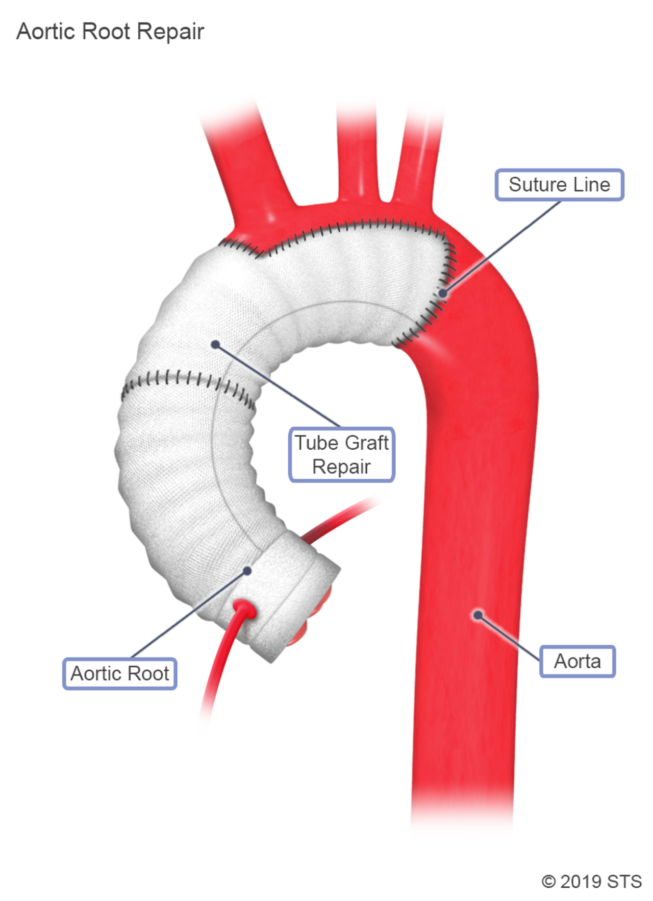 Thoracic Aortic Aneurysm Newport Cardiac Thoracic Surgery