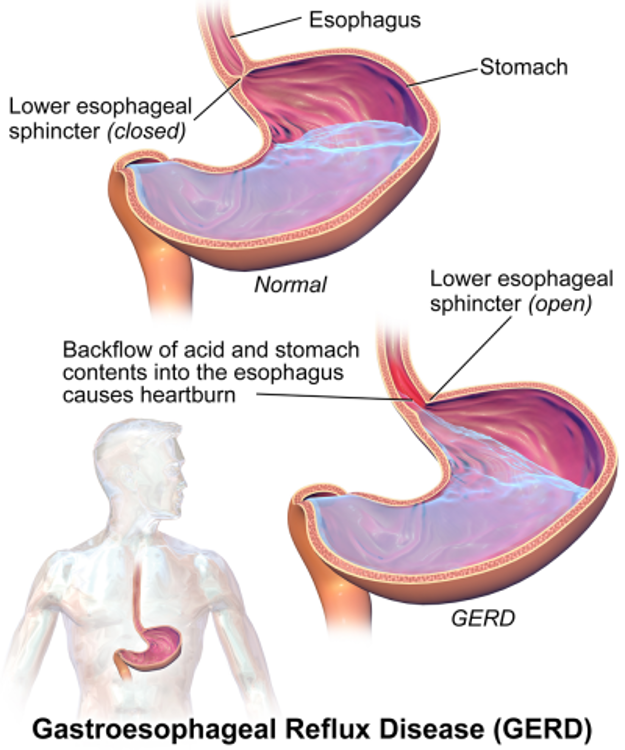 gastroesophageal-reflux-disease-newport-cardiac-thoracic-surgery