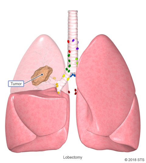 Lobectomy - Newport Cardiac & Thoracic Surgery