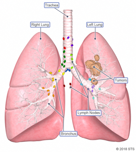 lung-cancer-newport-cardiac-thoracic-surgery