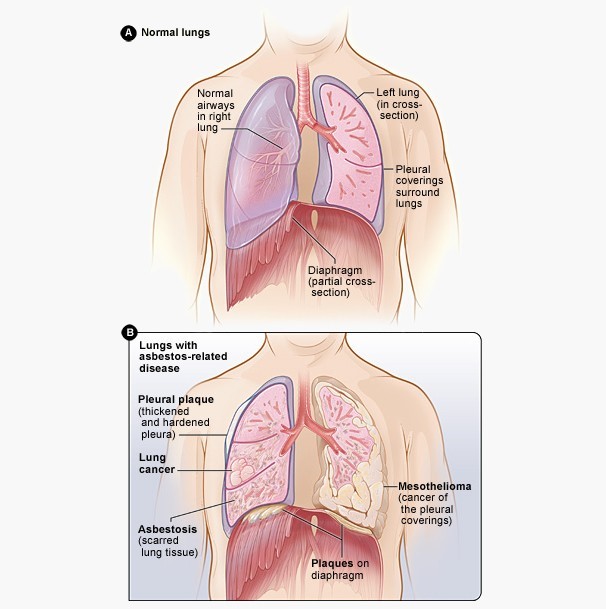 1. What is Mesothelioma?