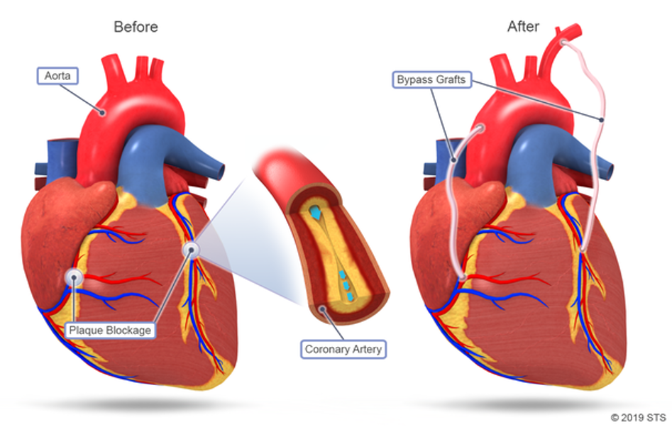 coronary artery bypass grafting icd 10 pcs