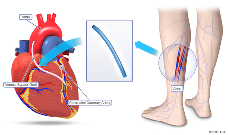 Critical Analysis of Coronary Artery Bypass Graft Surgery: A 30