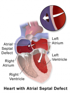 Atrial Septal Defect - Newport Cardiac & Thoracic Surgery