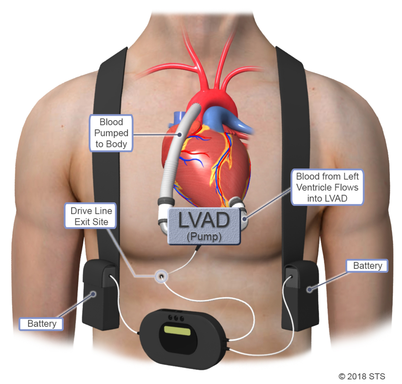 left-ventricular-assist-device-newport-cardiac-thoracic-surgery