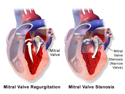 Mitral Valve Disease - Newport Cardiac & Thoracic Surgery