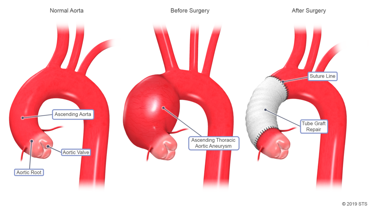 transplantaat voor thoracaal aorta-aneurysma